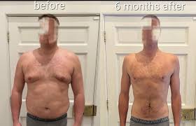 weight loss surgery in nyc bariatric