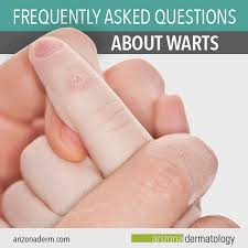 7 frequently asked questions about warts
