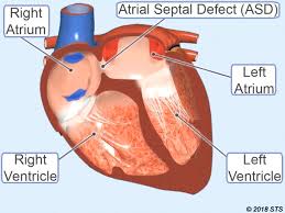 And if you know you have a pfo, it's worthwhile to see a cardiologist. Atrial Septal Defect The Patient Guide To Heart Lung And Esophageal Surgery