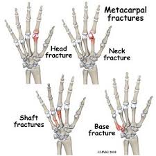 metacarpal fractures physiopedia