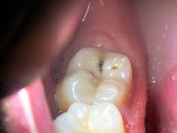 Amalgam fillings that cover three or more surfaces of the tooth run from $120 to $300. How Much Does A Cavity Filling Cost Howmuchisit Org