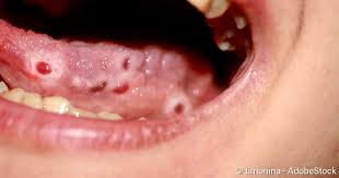 Das früheste und wichtigste zeichen der glossitis ist zu taubheit und brennen bei der verwendung von heißen oder würzigen speisen betrachtet. Mundfaule Symptome Behandlung Vorbeugung Netdoktor