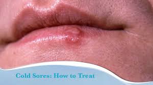 cold sores tips for managing