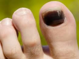 black toenail 6 potential causes