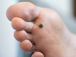 plantar warts everything you need to know