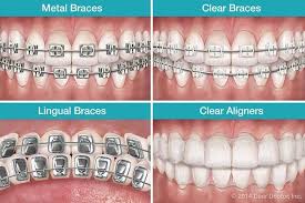 Adult Dental Braces that are Inexpensive