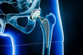 hip replacement surgery and its types
