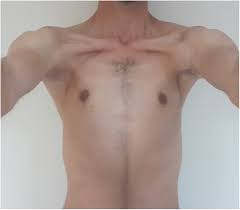 Chest involvement in moderate form of poland's syndrome. References In Is Multiple Bilateral Thoracic Anomaly Different From Poland S Syndrome The Annals Of Thoracic Surgery