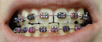 Braces with dental insurance cost. Average Cost Of Braces Best Orthodontist Nyc