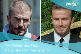 Check spelling or type a new query. 10 Celebrity Men Who Have Have Had Hair Transplants Hwt Clinic Blog