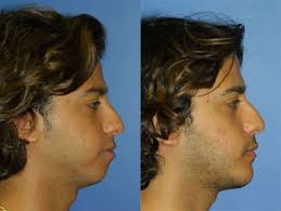 chin implants and reduction in new york