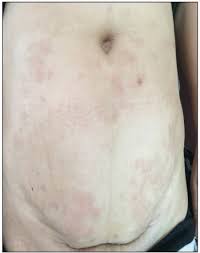 The bumps are usually on the hands and feet. Scielo Brasil Coexistence Of Morphea And Granuloma Annulare A Rare Case Report Coexistence Of Morphea And Granuloma Annulare A Rare Case Report