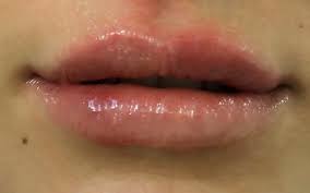 It is mainly used as a lip booster, but can also crease wrinkles, such as the nasolabial fold. Filler Vorher Nachher Bilder Lippen Vorher Nachher