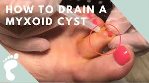 how to drain a myxoid cyst on the toe
