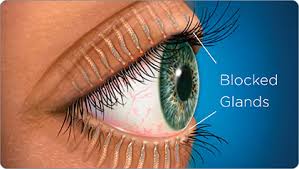 dry eye treatment valley optometry