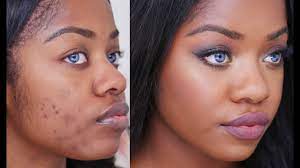 how to cover acne scars on dark skin