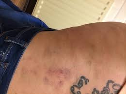 itching and bruising