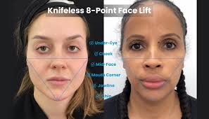 8 point face lift the needle taking