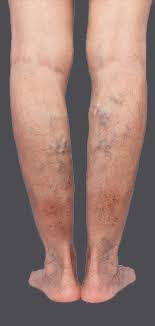 varicose vein treatment in singapore a