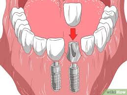 During veneer preparation, a dentist reshapes the exterior surface of the teeth. How To Straighten Your Teeth Without Braces With Pictures