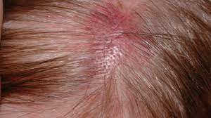 recurring scab on scalp in the same