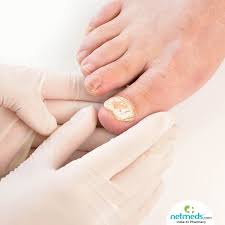 fungal nail infection causes symptoms