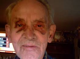 Image result for images of old man with bruises on his face