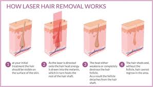 Image result for Laser Hair Removal