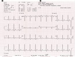 Paper For Schiller Cardiovit At 10 Plus And At 110 Single Pack