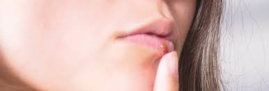 cold sore vs pimple on your lip how