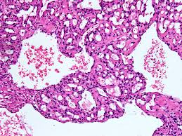 pathology outlines hemangioma variants