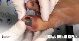 ingrown toenail the foot clinic santa ana