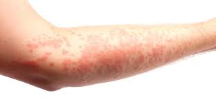erythema types causes symptoms and