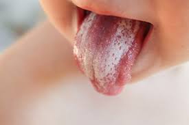 what s this white spot on my tongue