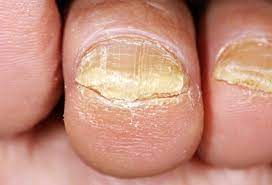 why do our toenails thicken as we age