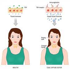 what is thyroid eye disease and can it