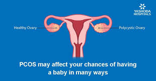 Pcos is a genetic, hormonal, metabolic and reproductive disorder that affects 10 percent of women. Polycystic Ovary Syndrome Pcos Causes Symptoms Diagnosis And Treatment