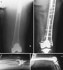 distal fem periprosthetic fractures