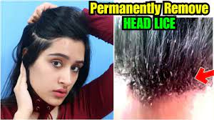permanent removal of hair lice