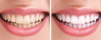 Using an aluminium foil to wrap this mixture and leaving it on helps in breaking down the stain molecules on your teeth and gives you brighter and whiter teeth. See Fast Results With Best Teeth Whitening Kit Common Diy Teeth Whitening Formulas Best Teeth Whitening