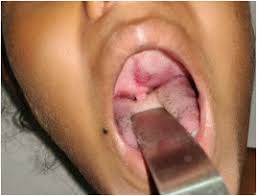 Hand, foot and mouth disease is a viral illness that typically occurs in infants and children up to five years old, according to the centers for disease control and prevention (cdc). Soft Palate Mass An Unusual Case Sciencedirect