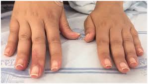 pincer nail in a lupus patient t h v