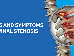 signs and symptoms of spinal stenosis