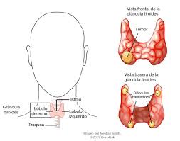 Además todos los tumores anaplásicos de tiroides se clasifican como en estadio iv al momento del diagnóstico, independientemente del tamaño, la ubicación o la diseminación del tumor. All About Thyroid Cancer Oncolink