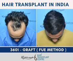 cost of hair transplantation in india