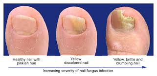 laser for nail fungus nyc toenail