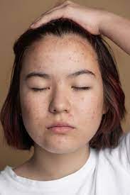 pimple face images free on