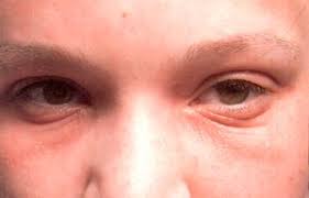 the eyes and atopic eczema