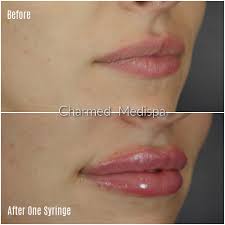 lip filler journey and what to expect