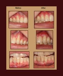 gum grafting dental implants chandler